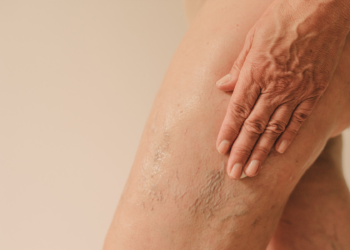 Crepey Pores and skin On The Legs: Causes, Therapies & Extra
