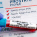 Prostate Most cancers: Why Black Males Ought to Be Screened